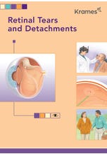 Retinal Tears and Detachments