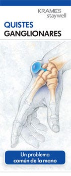 Ganglion Cysts (Spanish)